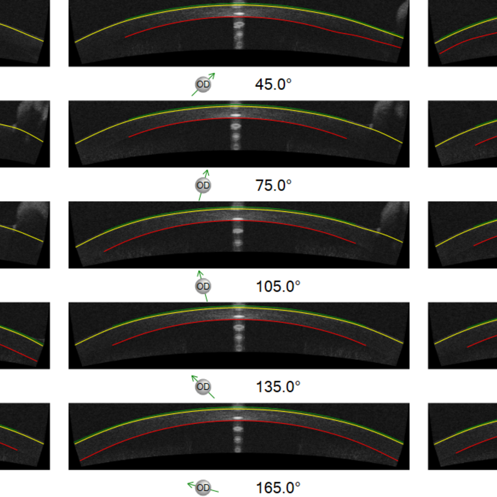 Corneal Scans