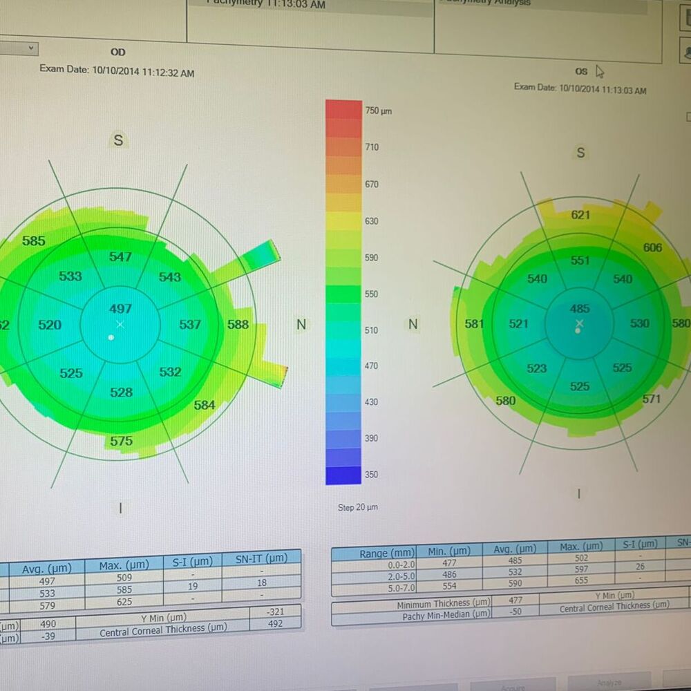 Pachymetry analysis