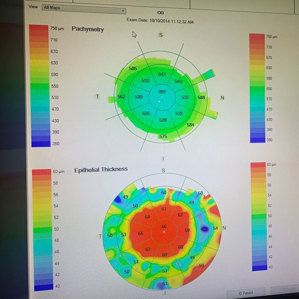 Epithelial thickness analysis